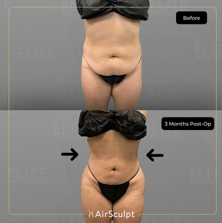 Can You Get Rid of Apron Belly? Proven Tips That Work Fast 3 can you get rid of apron belly