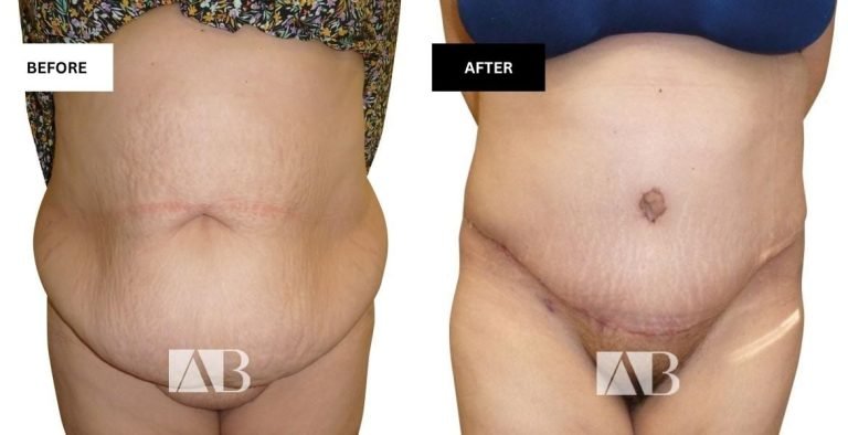 How Do I Get Rid of Apron Belly: Effective Tips That Work Fast 15 how do i get rid of apron belly