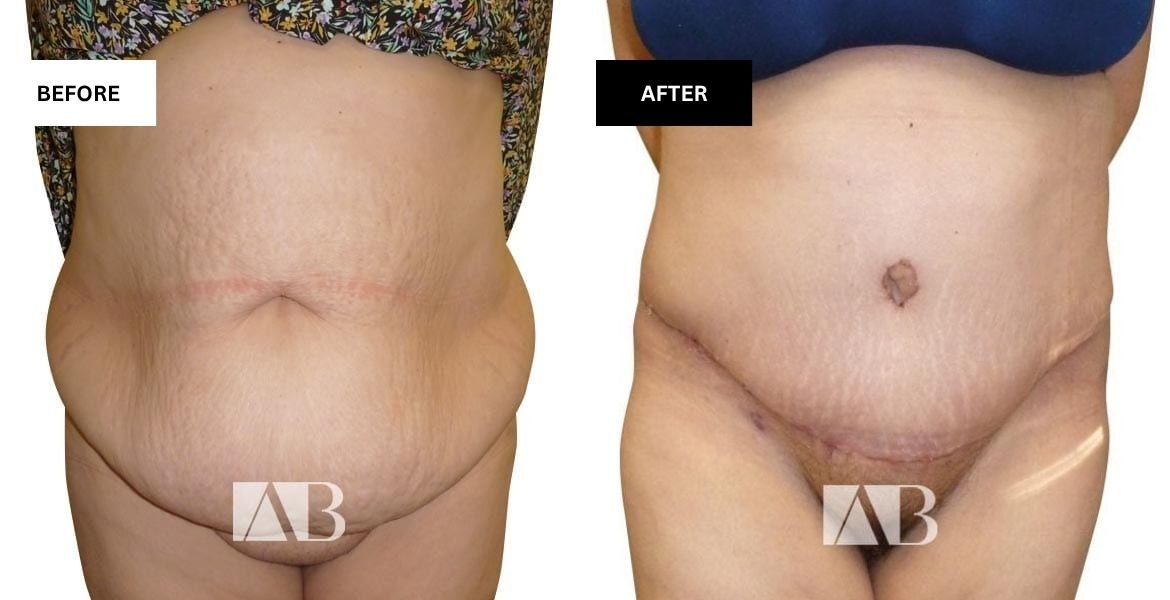 how do you get rid of apron belly