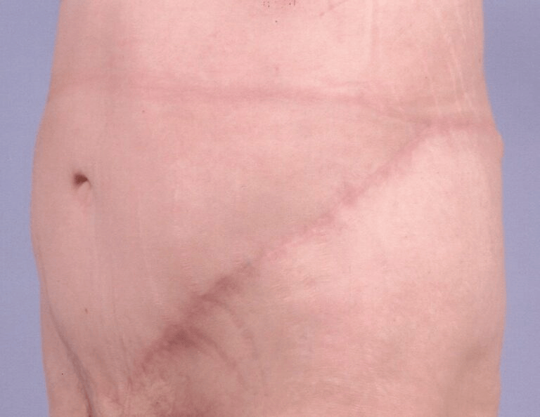 How to Get Rid of Apron Belly After C Section: Proven Tips That Work 19 how to get rid of apron belly after c section