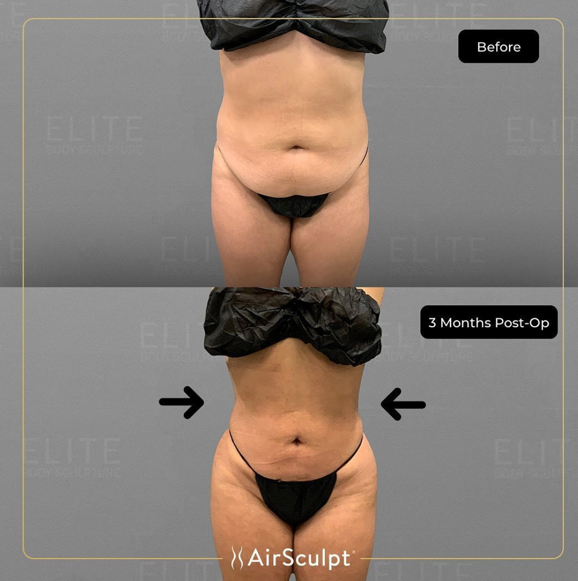 how to get rid of stomach apron