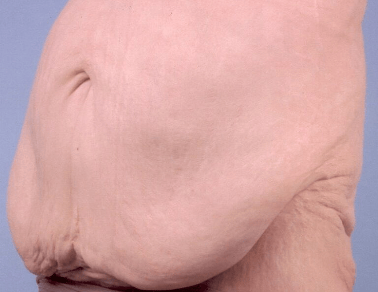 Is Apron Belly Surgery Covered by Insurance? Essential Facts Revealed 1 is apron belly surgery covered by insurance